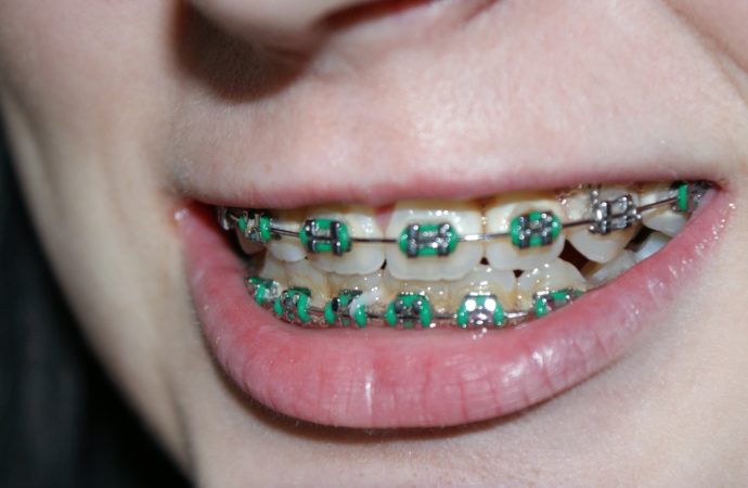 Behel Imitasi, Budaya Instan dan Mengesampingkan Dampak